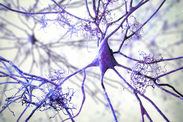 Amyloid-Tau- Neurodegeneration (ATN) Profile